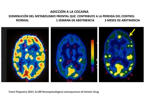 Imágenes del cerebro realizadas por tomografía de emisión de positrones (PET)