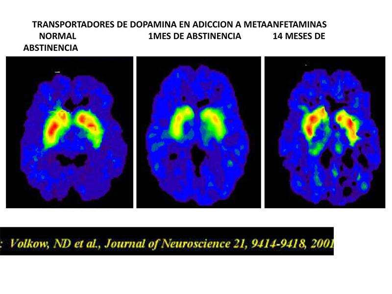 Imágenes del cerebro realizadas por tomografía de emisión de positrones (PET)